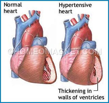 Hypertensive changes of Heart
