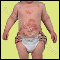 Infantile Eczema 