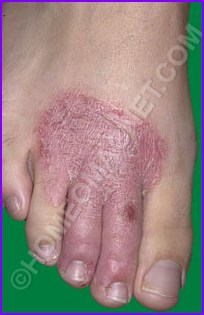 Eczema of Foot