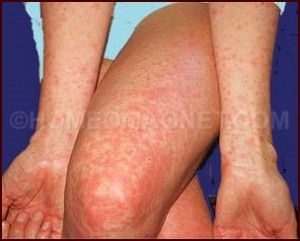How to Recognize and Treat Dengue Fever (with Pictures ...